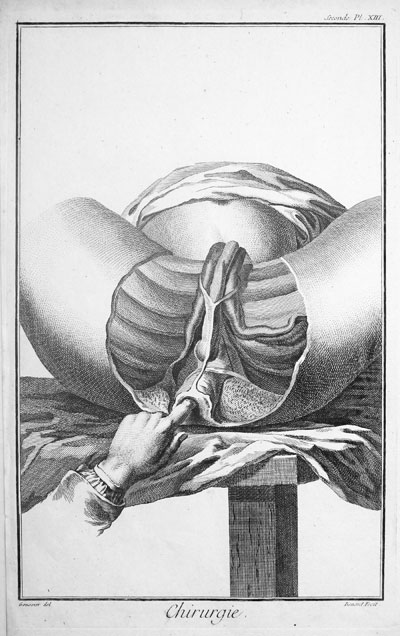 Surgical engraving by Denis Diderot 1760